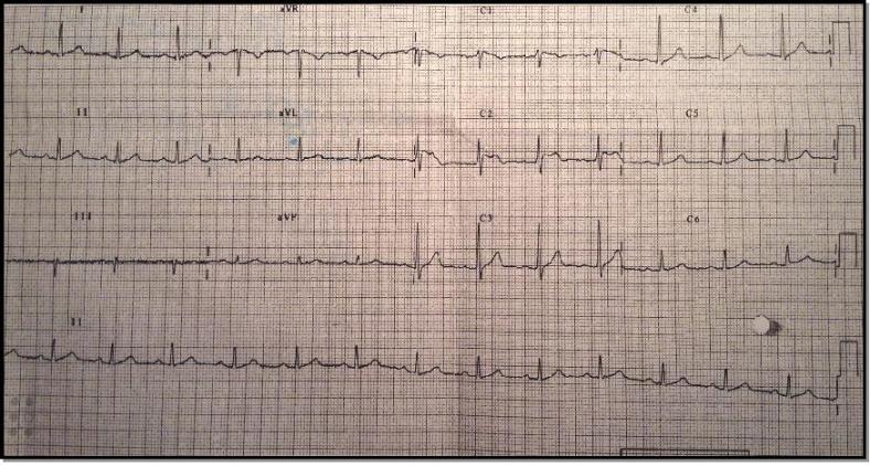 ecg afebril