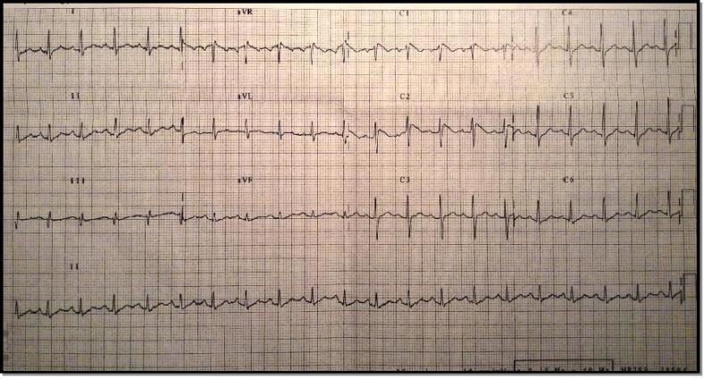 ecg febril